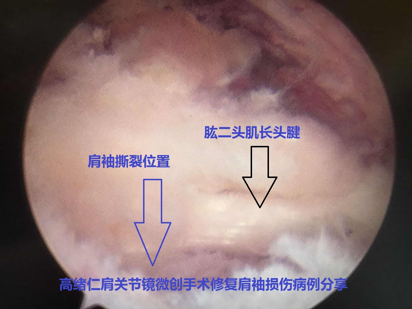 今天應邀到外院進行一臺肩關節鏡肩袖損傷修復手術.