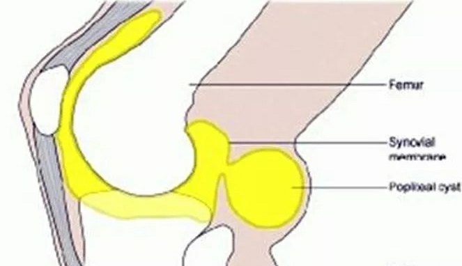 腘窝囊肿是指腘窝深部滑囊肿大或膝关节滑膜囊向后膨出的统称,其可