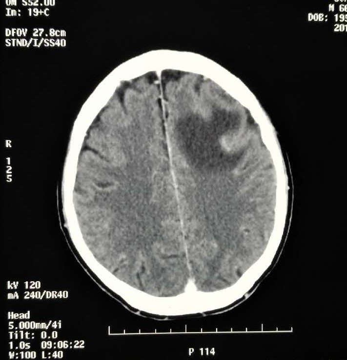 脑转移瘤最需要了解的干货(1):诊断方法