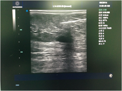 图1 注射局麻药.png 乳腺微创手术切除乳腺结节