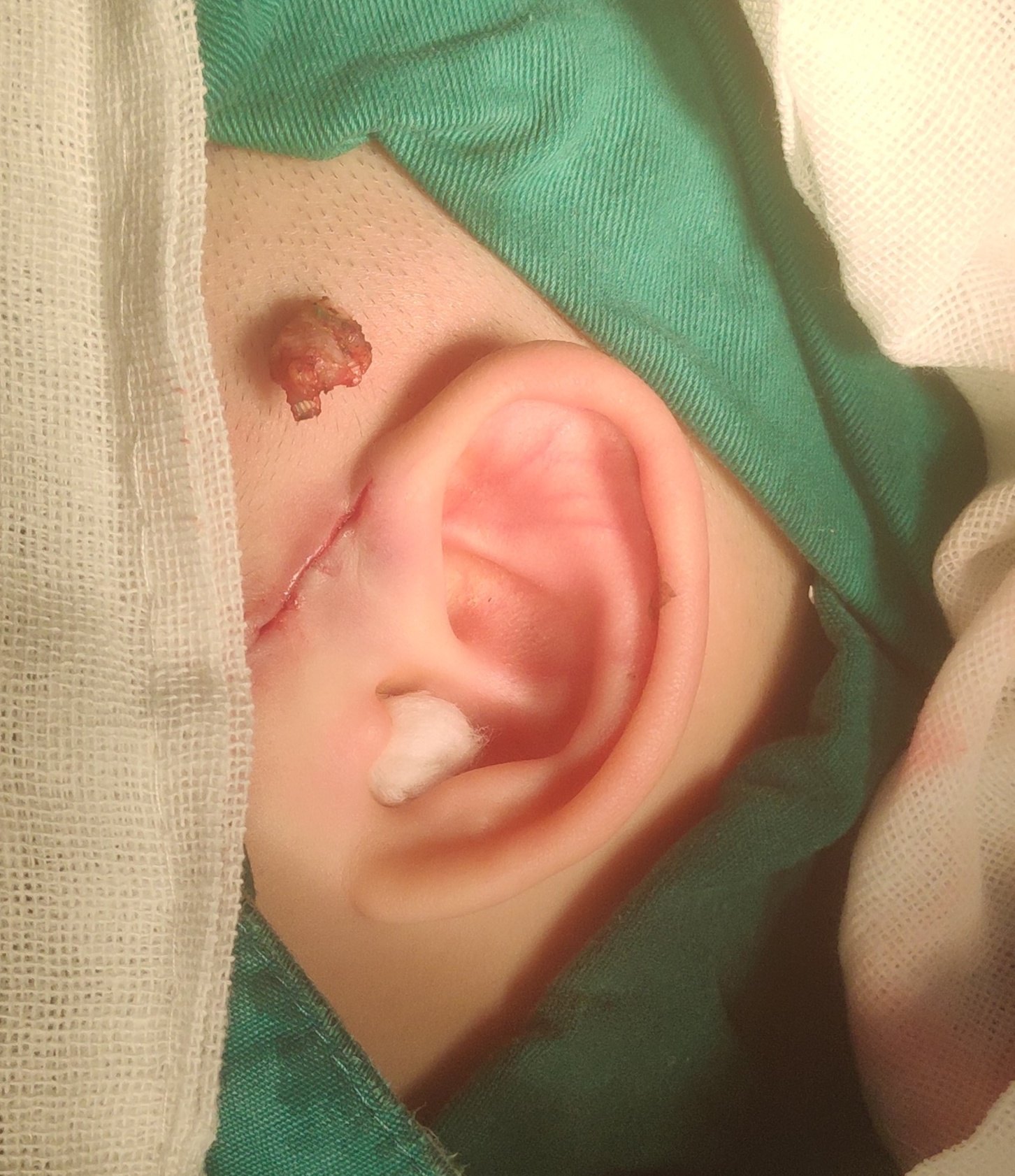 秦昊医生手记～20190313耳前瘘管切除术 - 好大夫在线