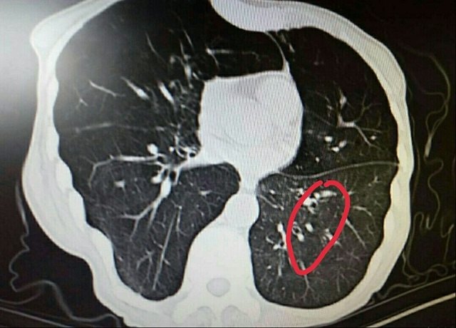 醫生告訴你慢阻肺的一生肺到底是如何一步步從健康走向氣腫