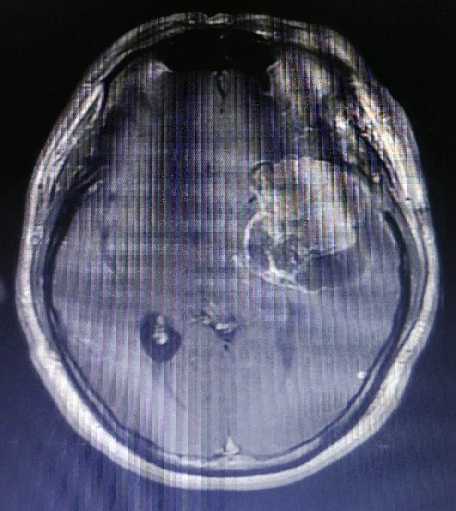 左颞叶脑膜瘤图片