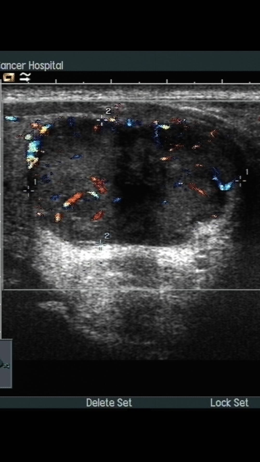 超声诊断甲状腺滤泡癌1例