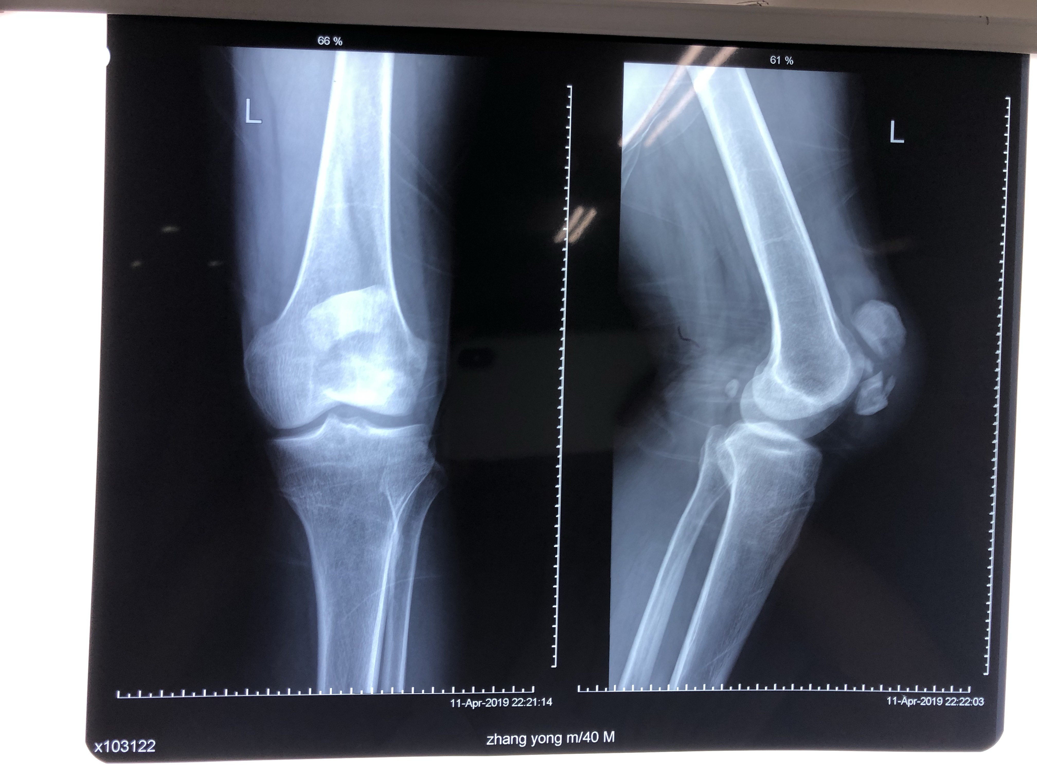 左髌骨粉碎性骨折图片图片