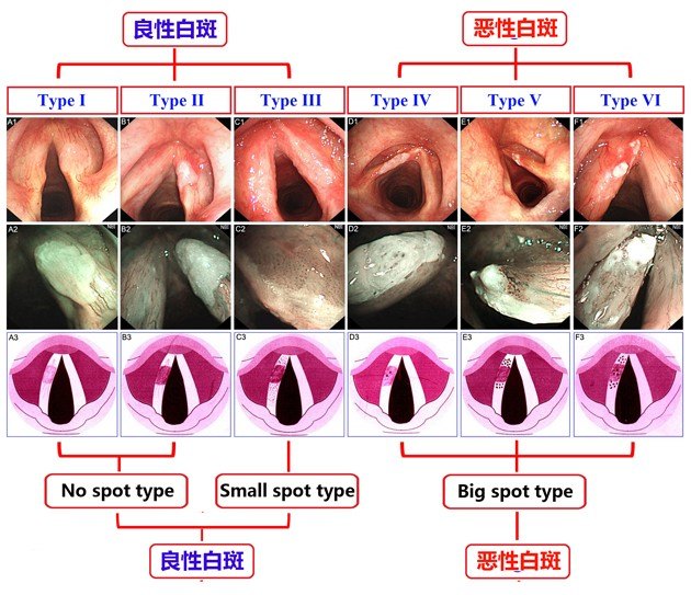 声带白斑图片高清,声带图,声带白斑(第2页)_大山谷图库