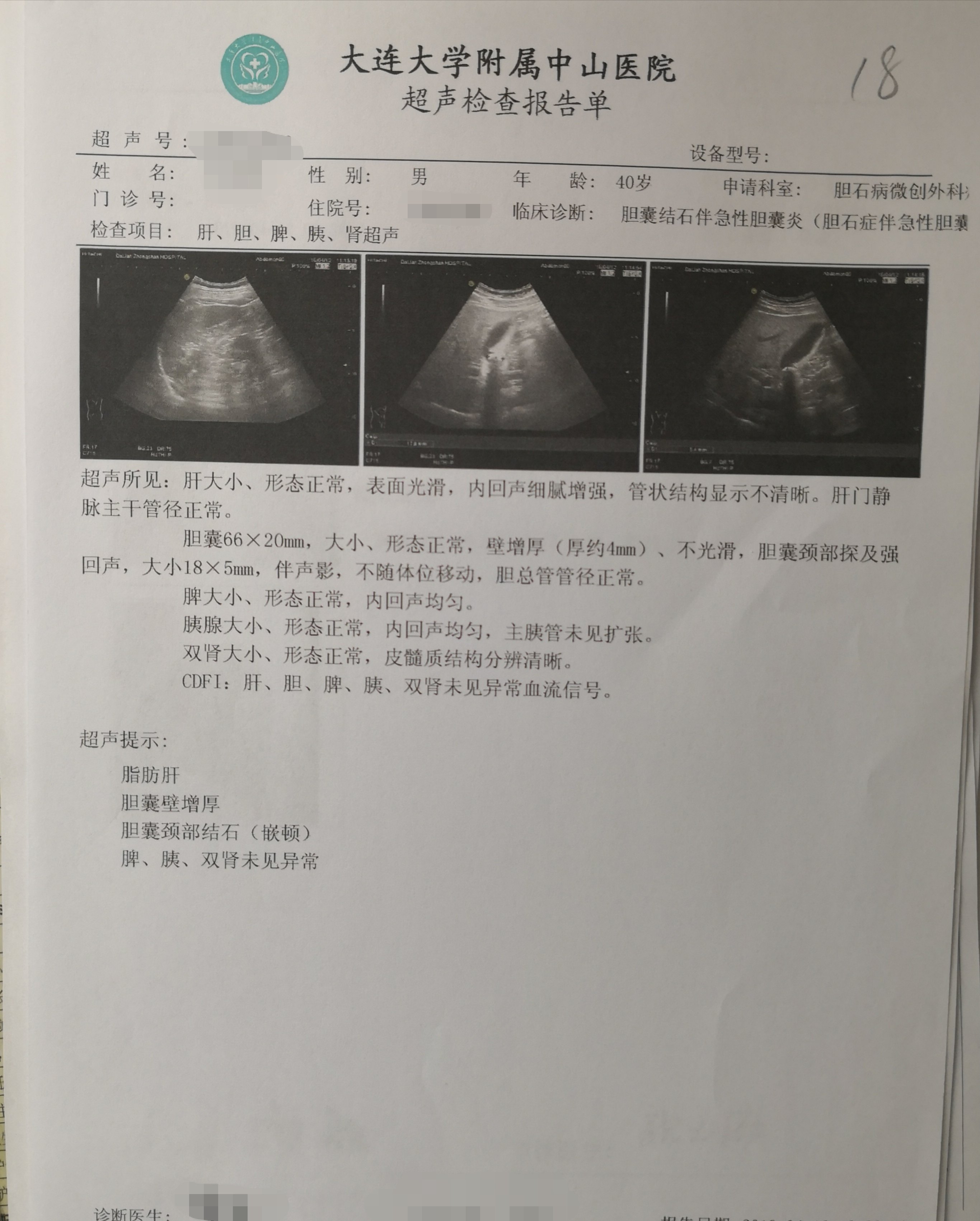 这种急性胆囊炎也可以保胆取石