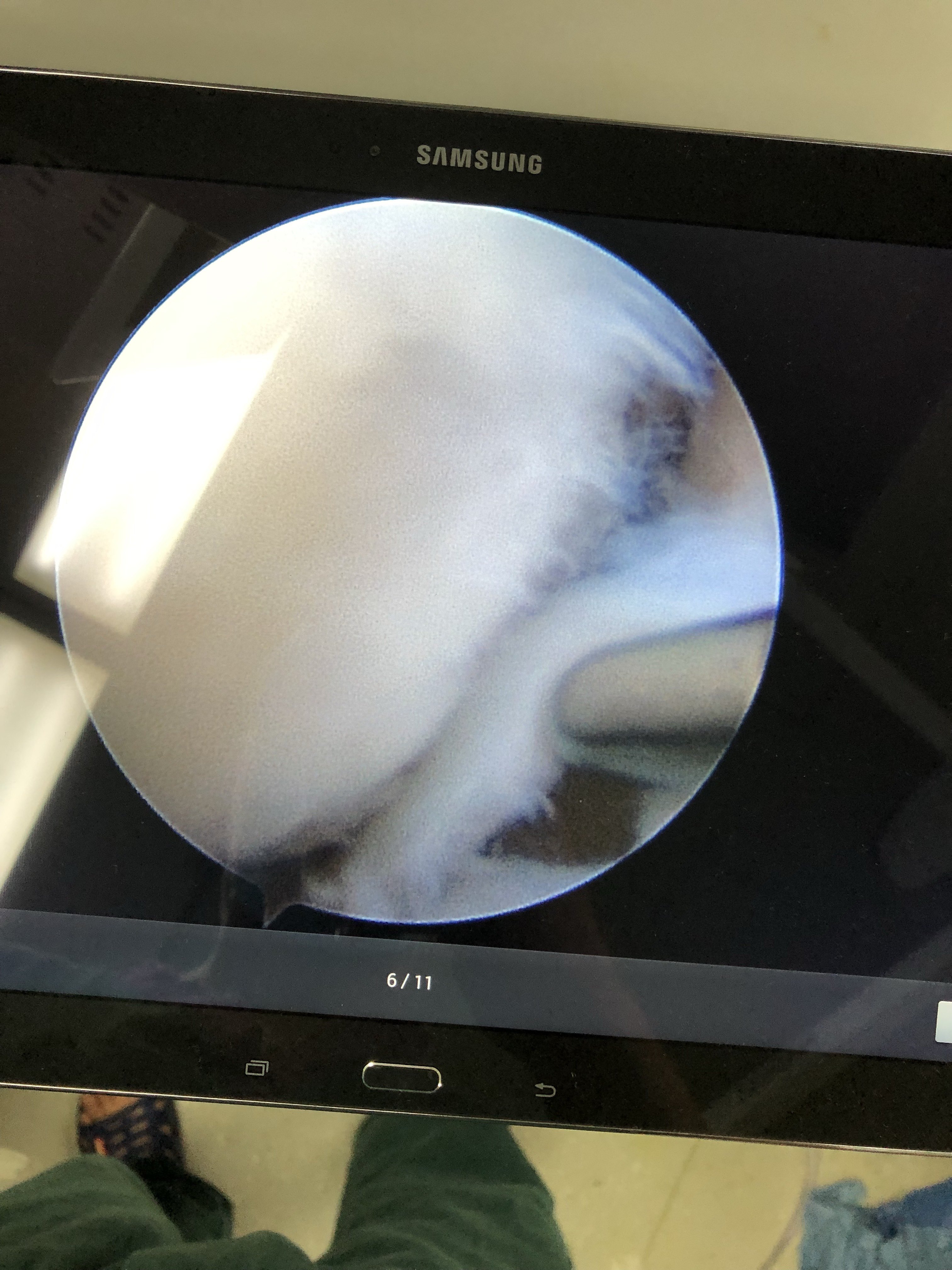 膝关节半月损伤,关节镜下修复 - 好大夫在线