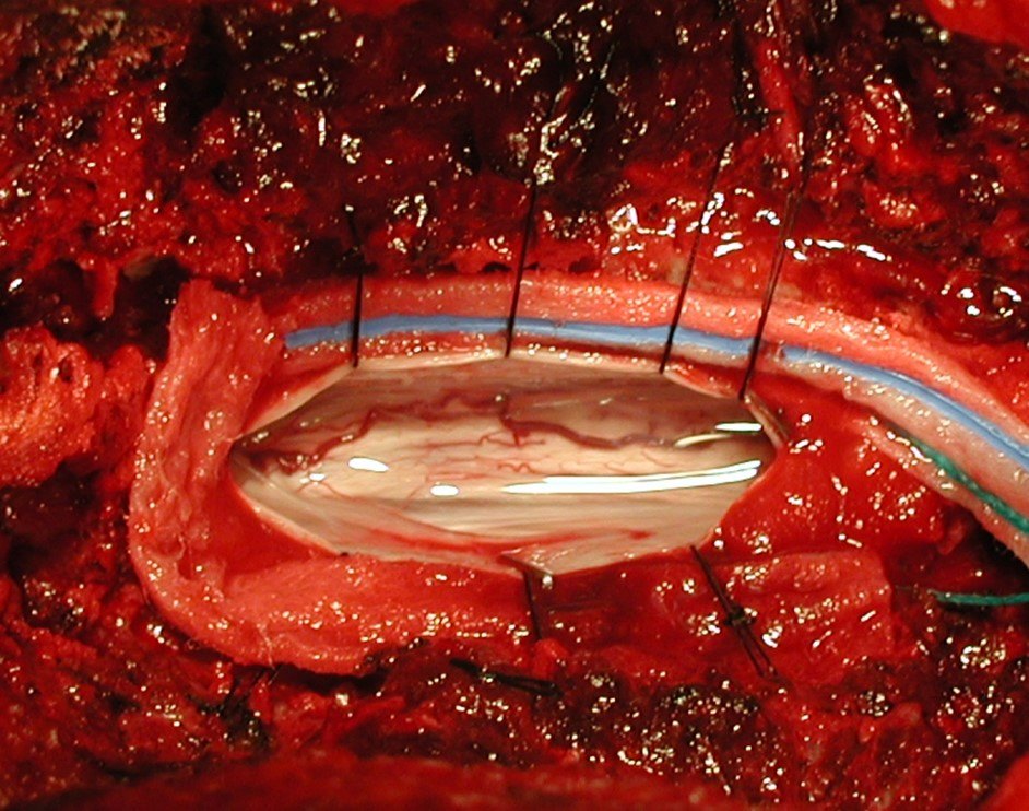 关于椎管内肿瘤,你需要了解的(二) - 好大夫在线