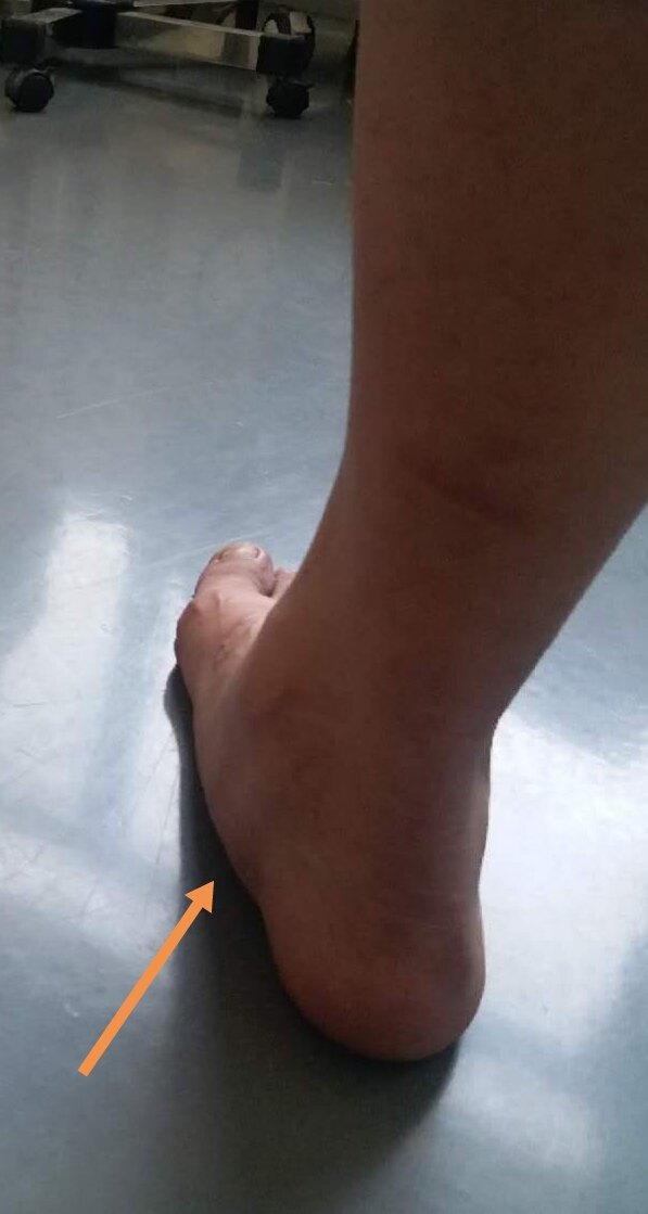 平足症! - 好大夫在线