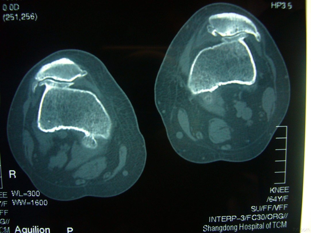 ct提示重度的髌骨关节炎本文是何帮剑版权所有,未经授权请勿转载.