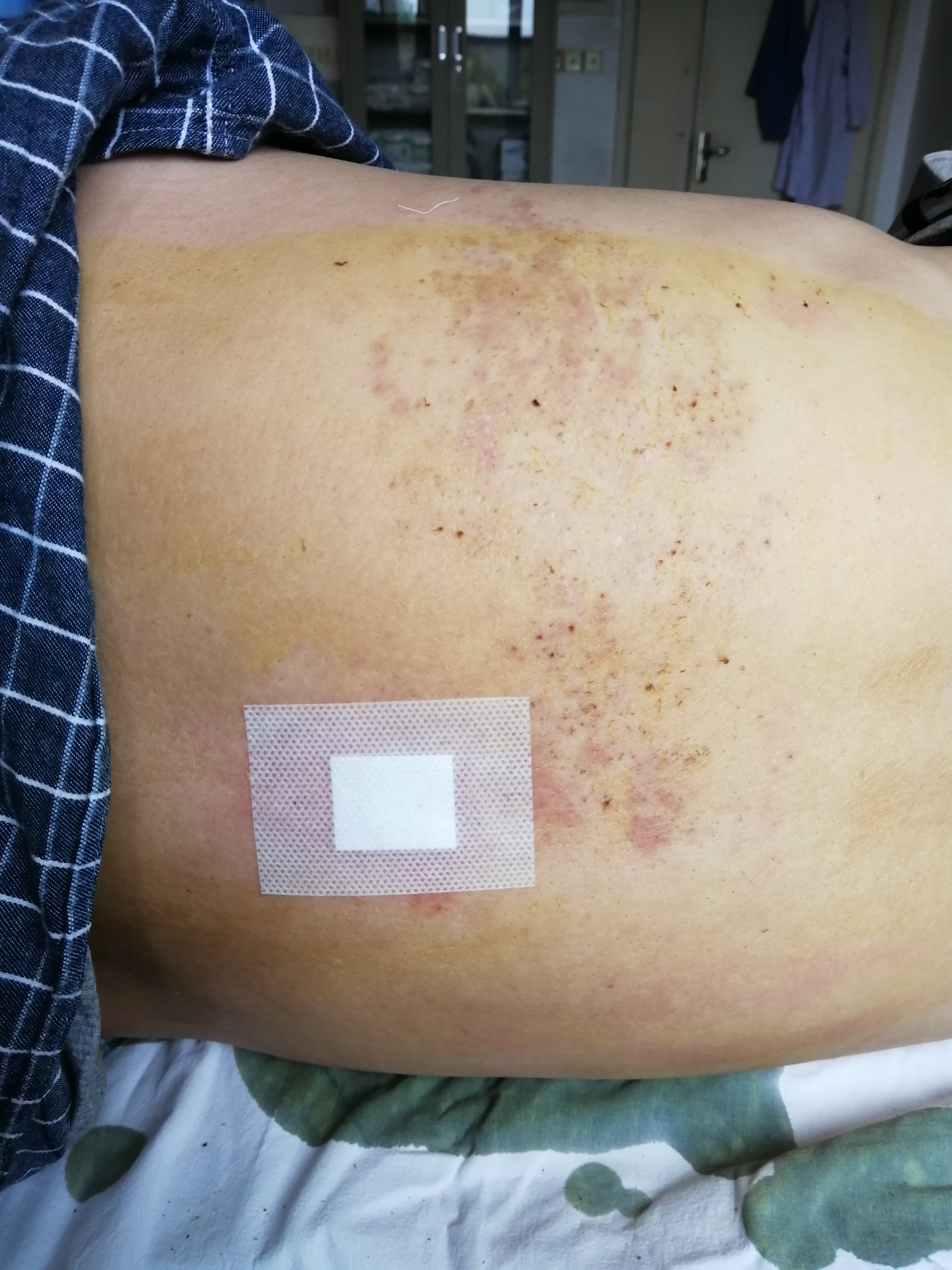 带状疱疹治疗病例 - 好大夫在线