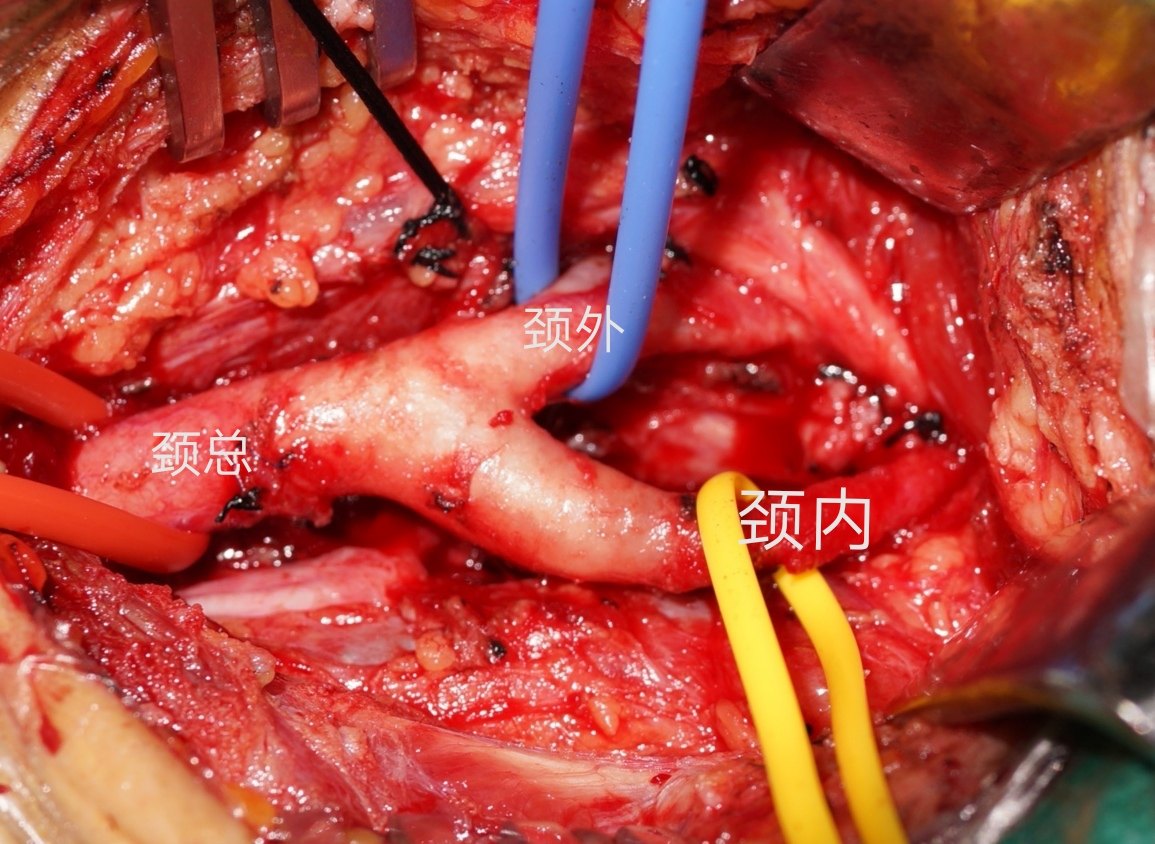 颈动脉体瘤位置图片图片