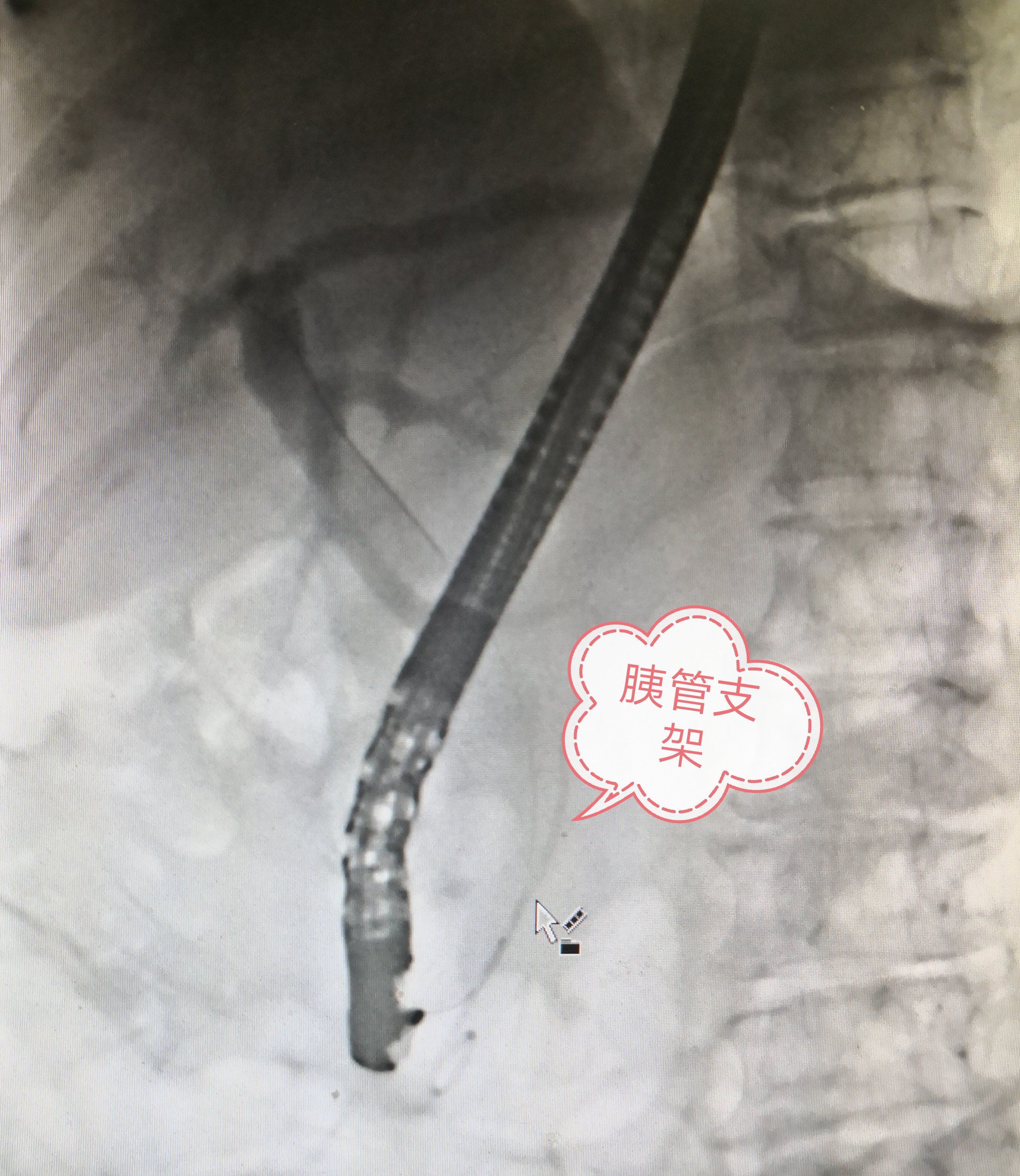 ercp治疗胆源性胰腺炎