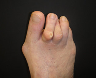 踇趾外翻时会向外侧侵占其他足趾的位置,导致临近足趾的屈曲畸形向上