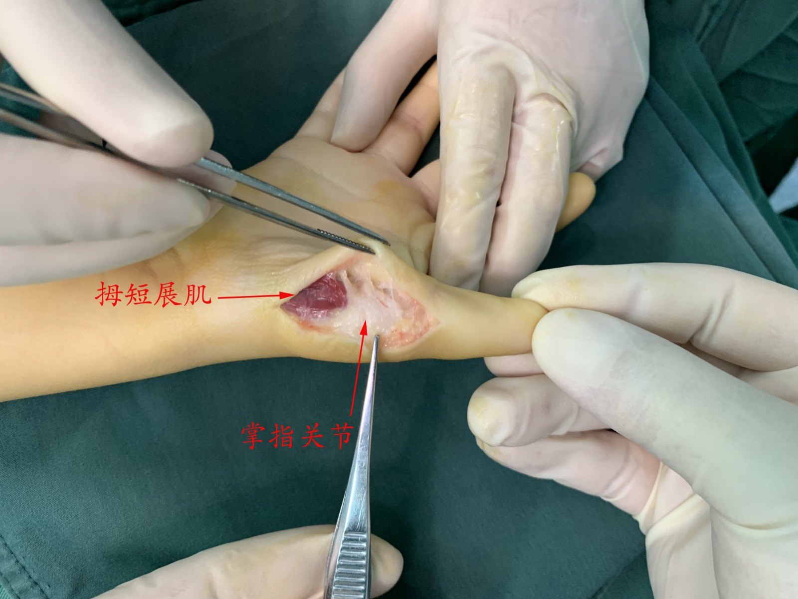 图五:术中拇短展肌重建于近节指骨近端,术后外观照.