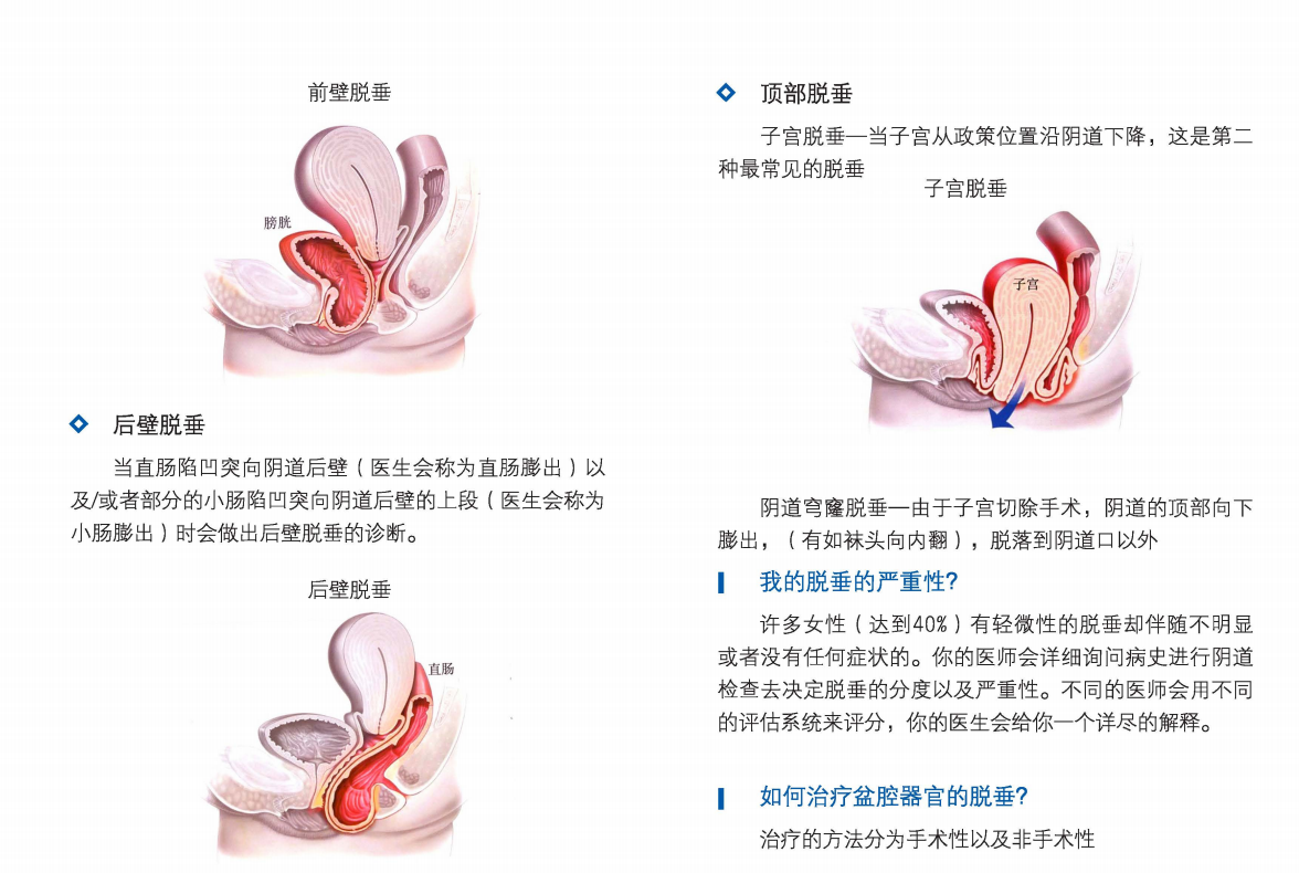 宫颈下垂症状图片