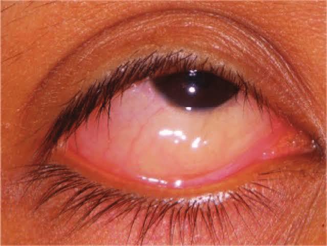 细菌性结膜炎特点非常明确,除了眼红,畏光流泪,异物感以外,其分泌物