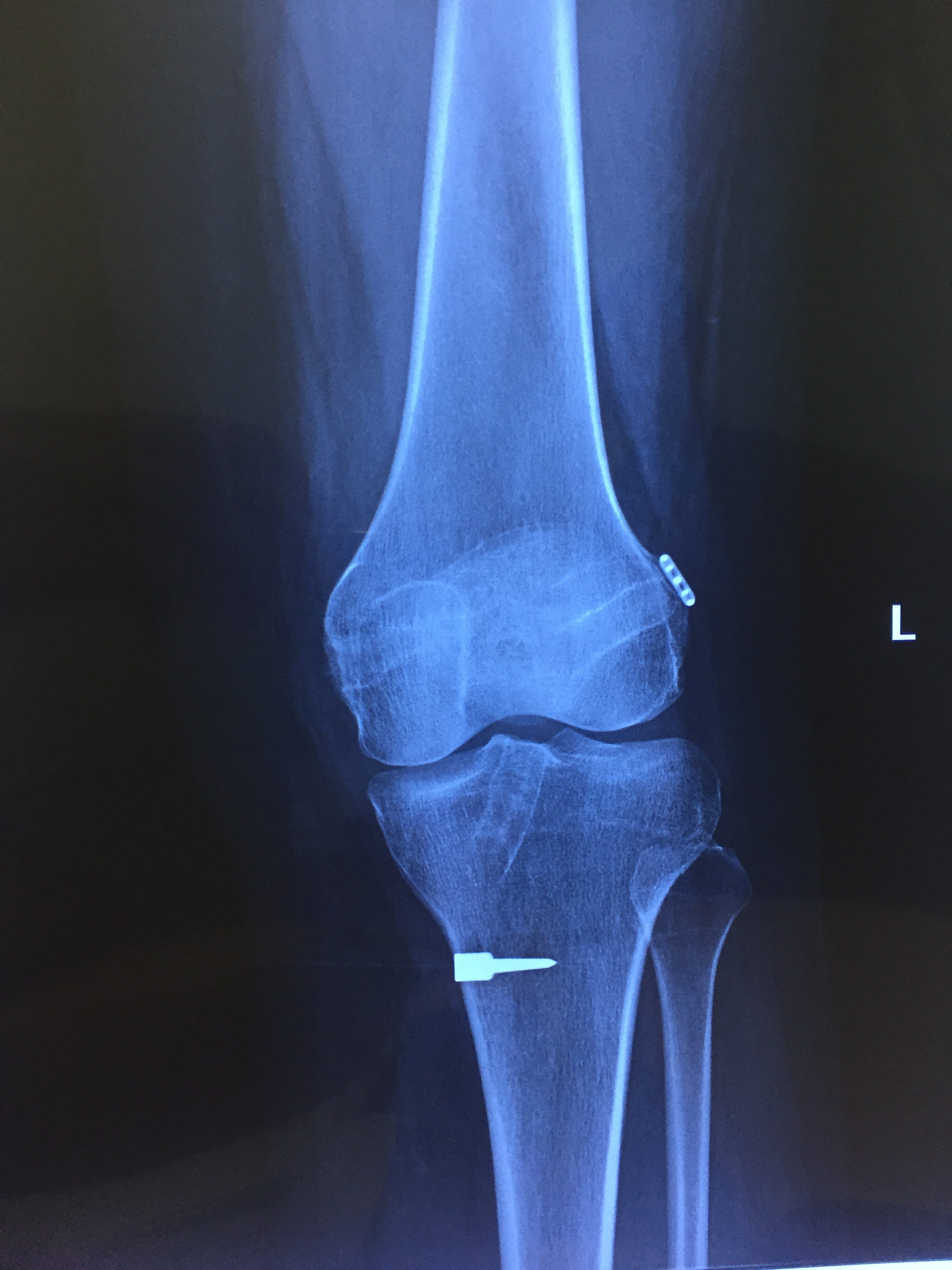 膝关节韧带损伤