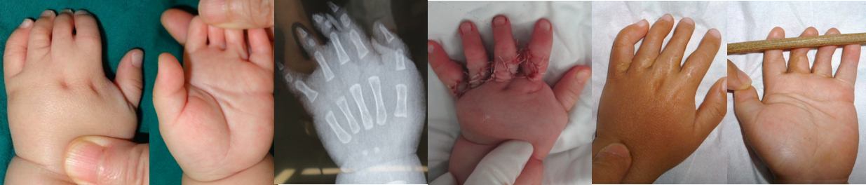 短指并指(波兰综合症):一次手术全部分离多个手指的并连_先天性并指多