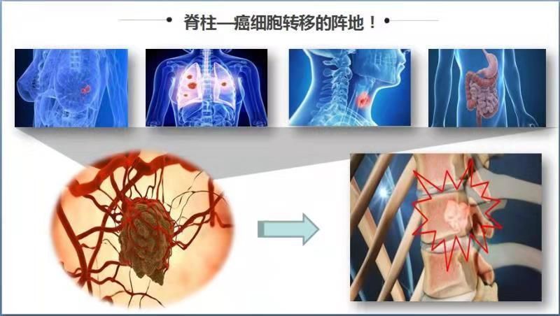 脊柱是肺癌,乳腺癌等惡性腫瘤的常見轉移部位,疼痛是最常見的症狀.