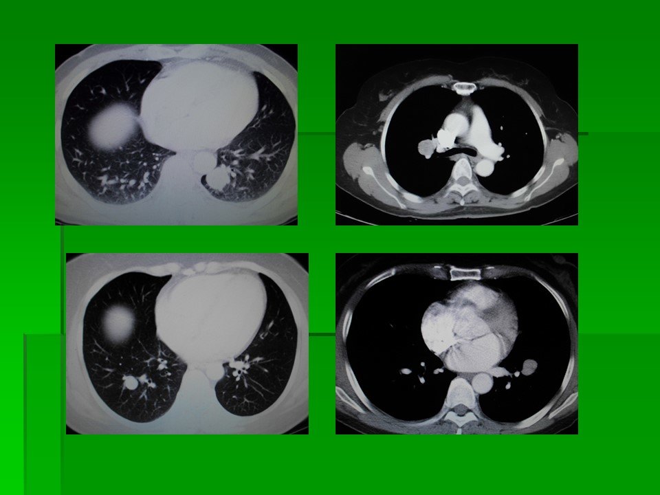 肺部良性肿瘤 肺硬化性肺泡细胞瘤 肺硬化性血管瘤是什么肿瘤 需要手术切除吗 肺肿瘤