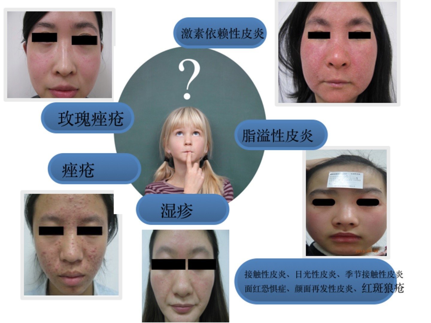 面部皮炎的诊断和鉴别1_皮肤病_皮肤病相关疾病 - 好大夫在线