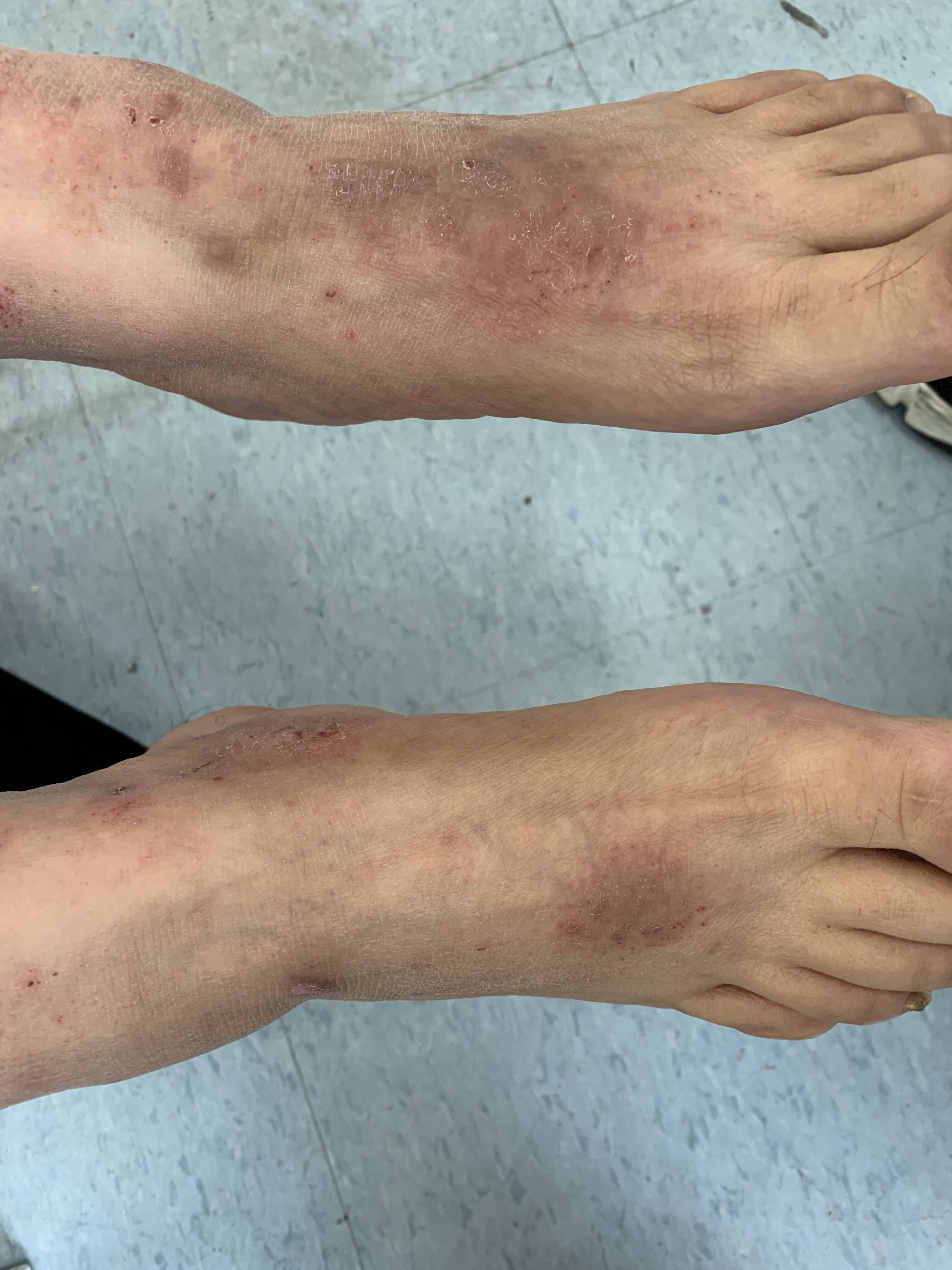 慢性湿疹 湿疹 湿疹 慢性湿疹 湿疹 湿疹