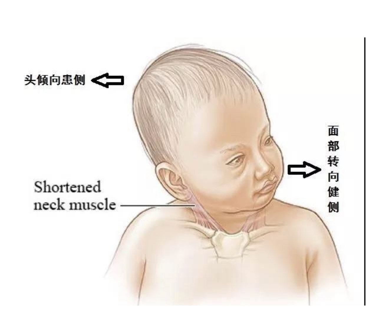 斜颈家庭护理图片