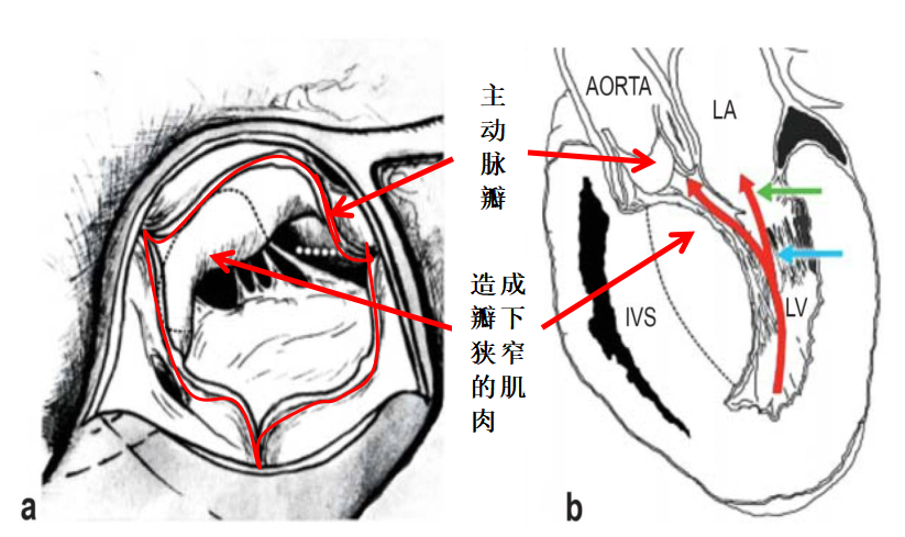 肥厚性心肌病的外科手术金标准——morrow手术,下刀究竟切哪里?