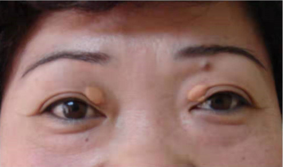 眼睑瘤的症状图片图片