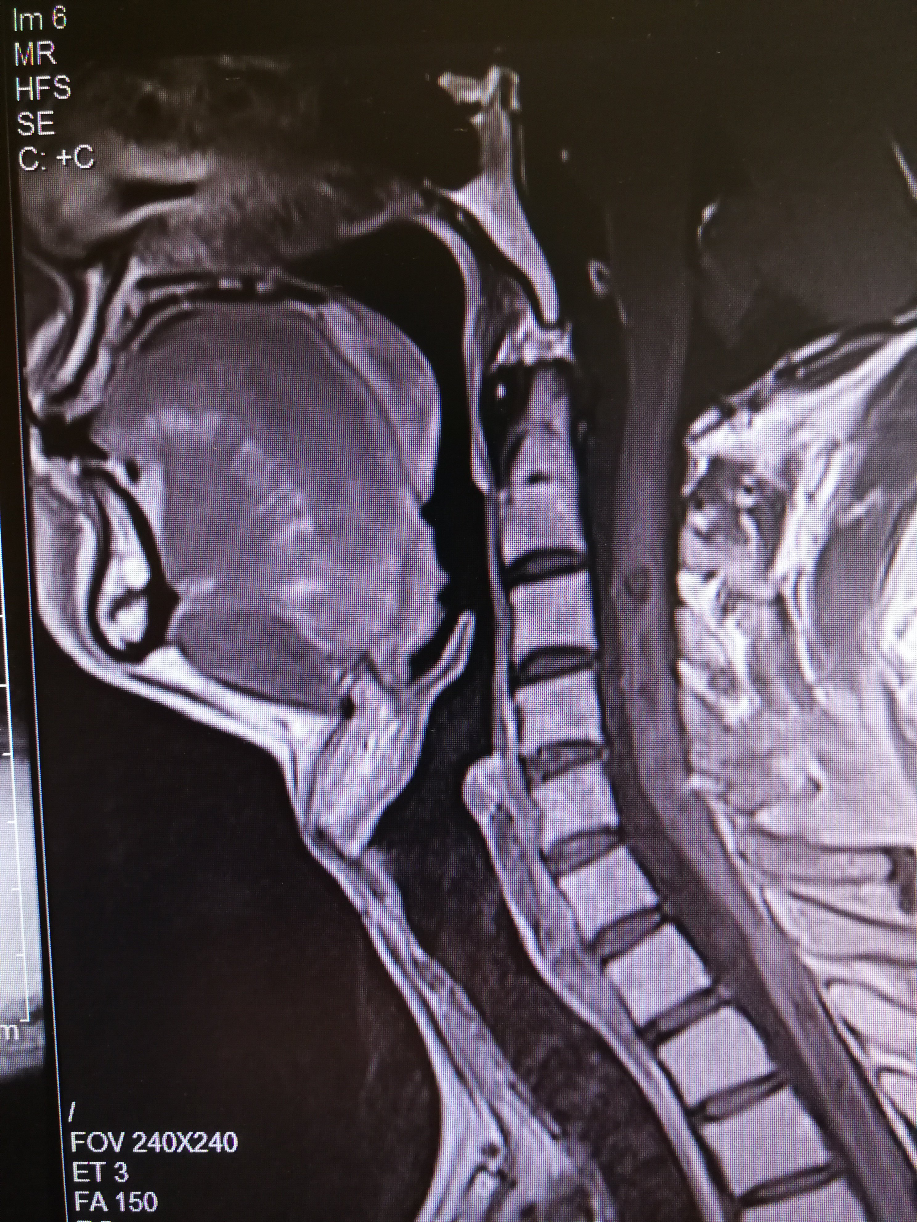 颈椎椎管内肿瘤切除术_椎管内肿瘤_椎管内肿瘤治疗方式 - 好大夫在线