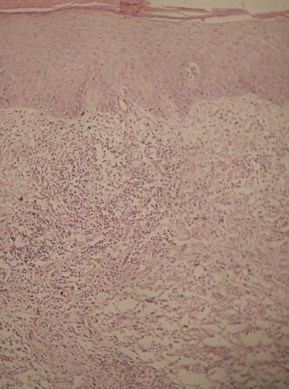 淋巴管孢子丝菌病图片图片