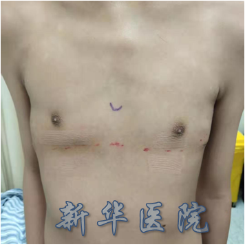 鸡胸微创手术治疗系列-8