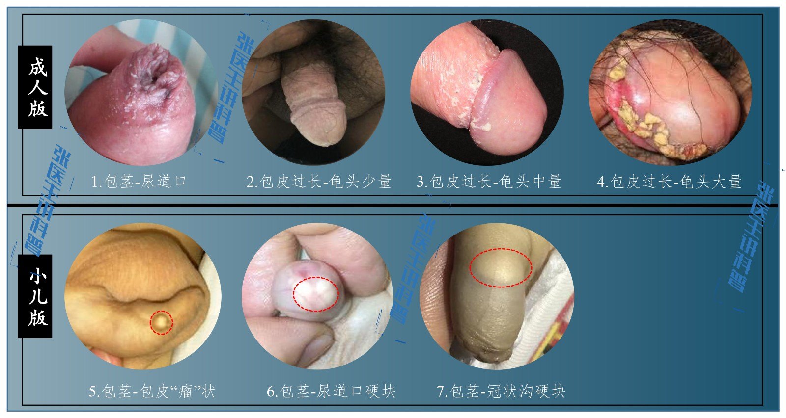 包皮过长 包茎 日常护理 教你男性 私处清洁 正确方法 包皮过长 好大夫在线