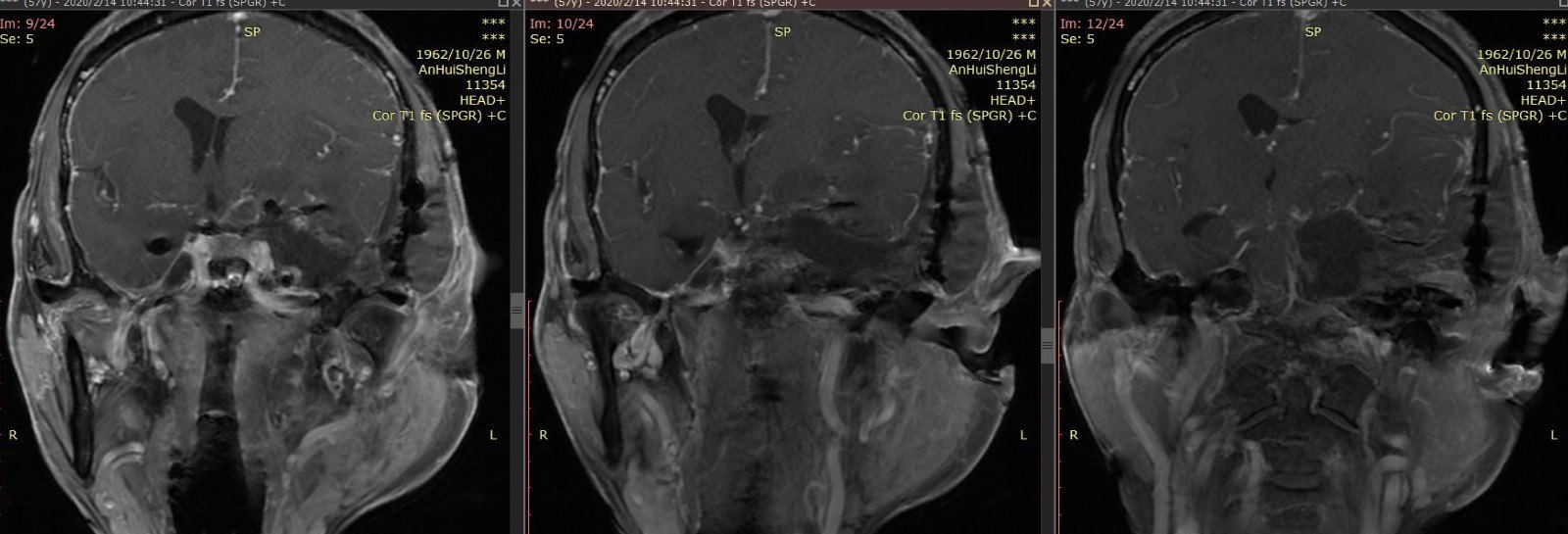 疫情下的巨大岩斜坡脑膜瘤-12.jpg