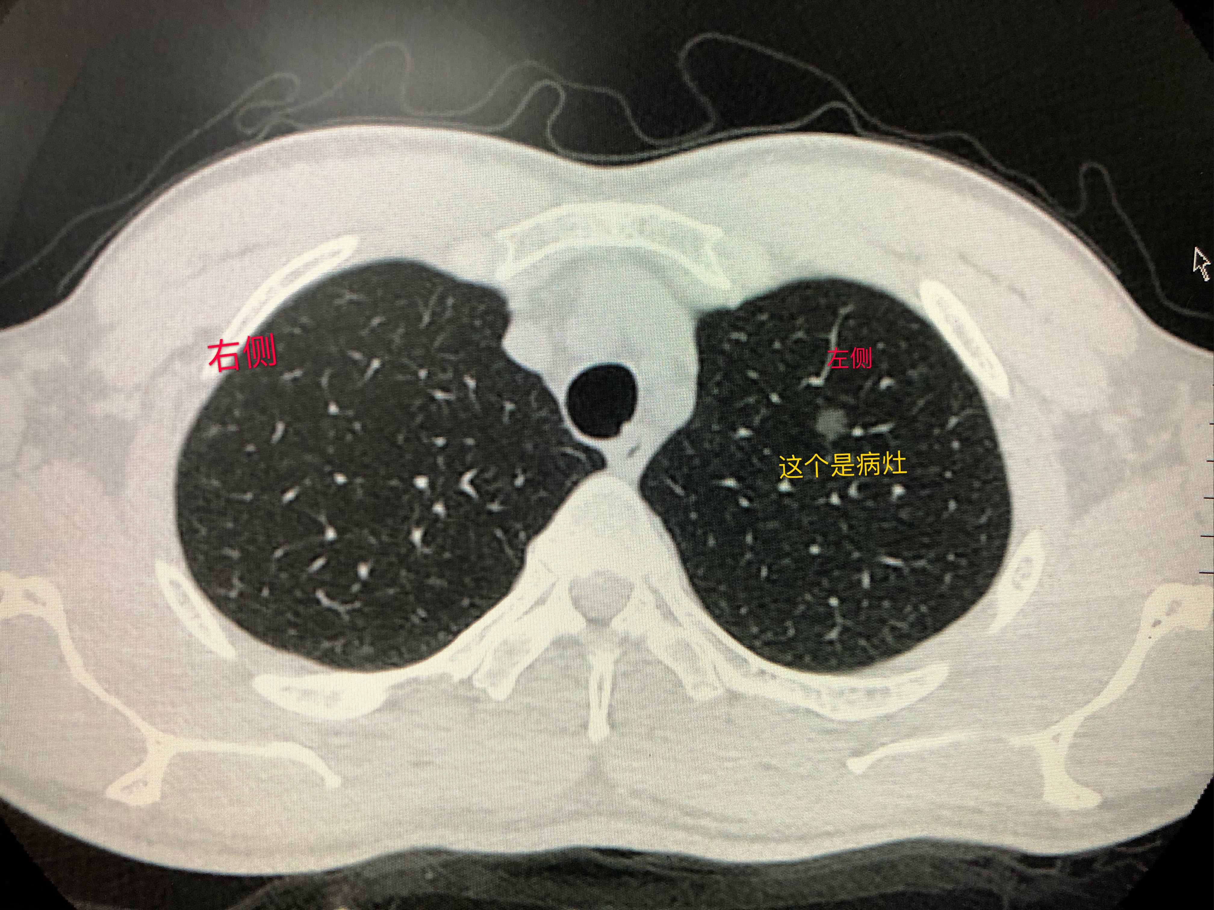 13mm肺混合磨玻璃结节图片