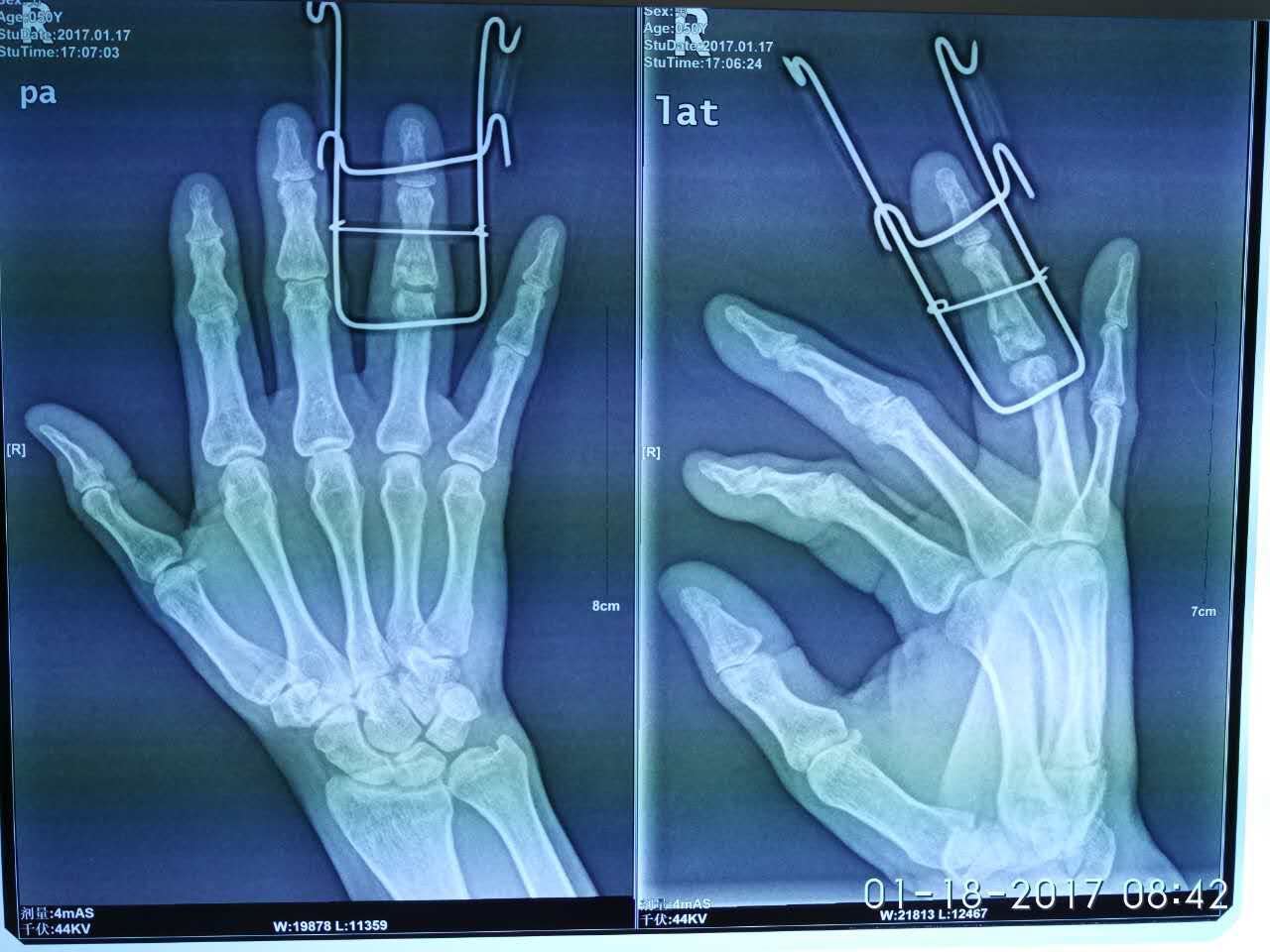 手指骨折微创手术 骨折 手指骨折微创手术 骨折