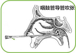 金尔康咽鼓管吹张器图片