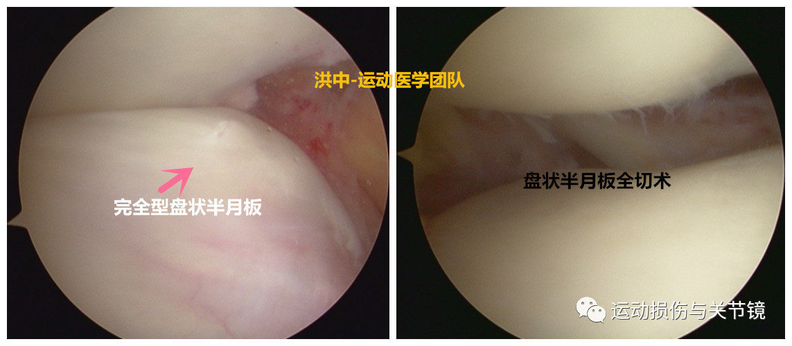 盤狀半月板損傷需警惕附關節鏡術後康復計劃