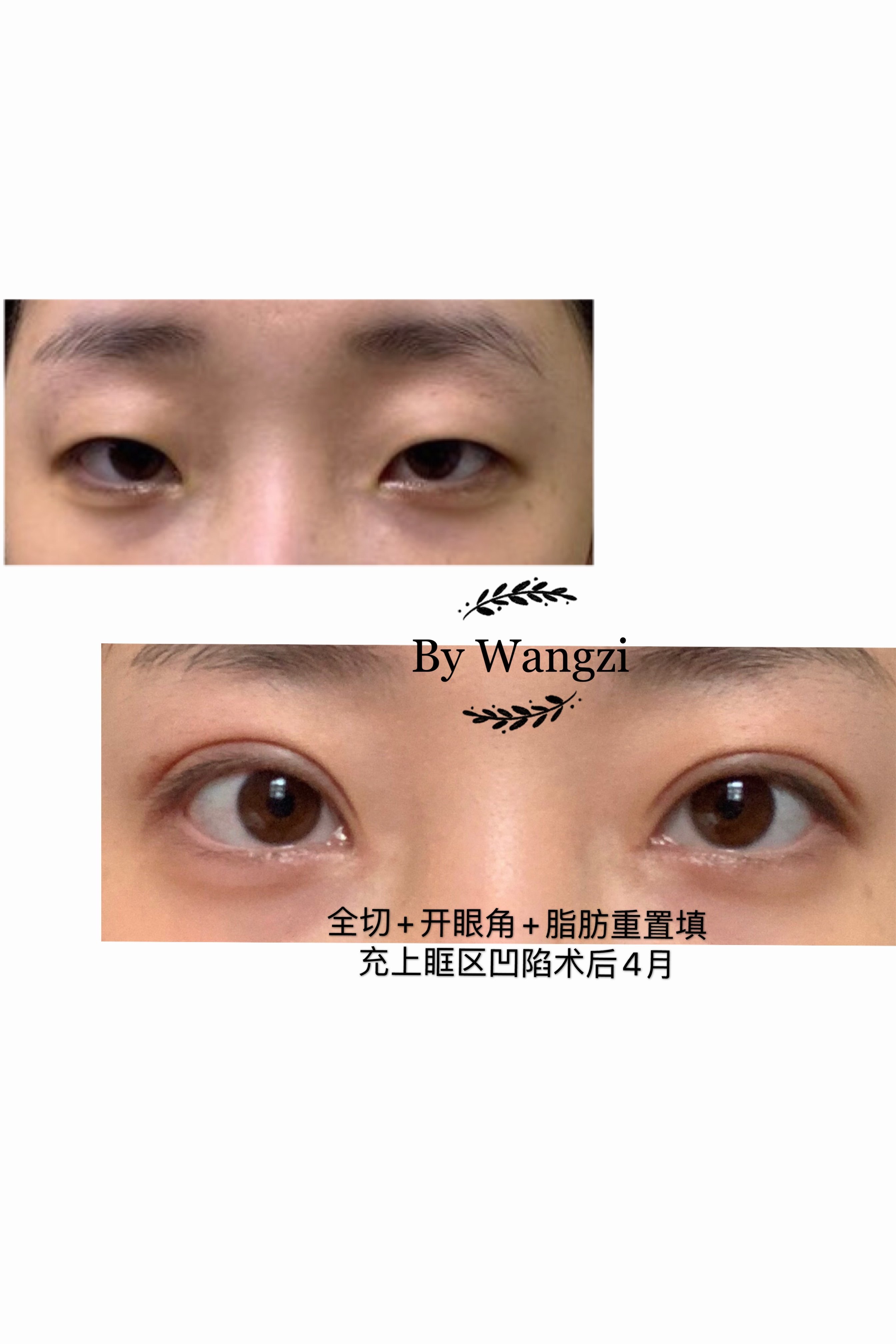 分享一些术前,术后对比照_双眼皮手术_双眼皮手术治疗介绍 - 好大夫