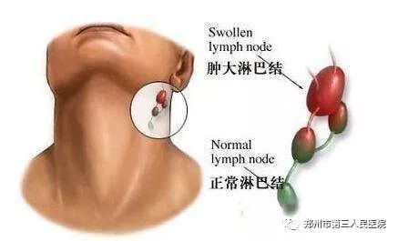 細菌,病毒或癌細胞等可沿淋巴管侵入淋巴結,淋巴細胞會產生淋巴因子和