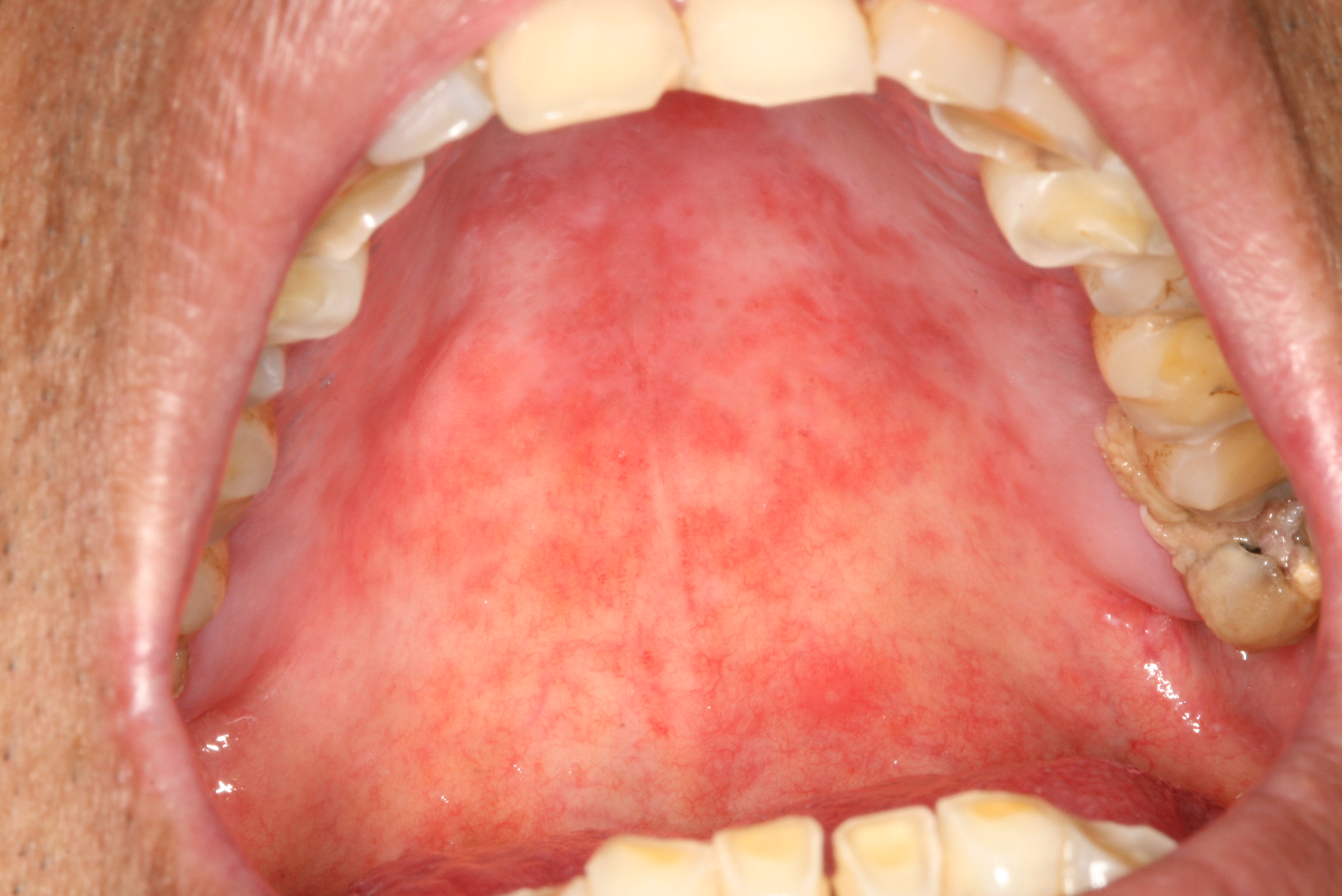 口腔潜在恶性病变2005年世界卫生组织建议将原先的口腔癌前病变与癌前