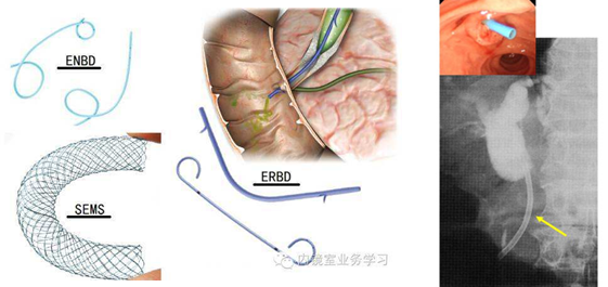什么是ercp Est Enbd 胆道支架术 有哪些常见并发症 胆结石 好大夫在线 什么是ercp Est Enbd 胆道支架术 有哪些常见并发症 胆结石 好大夫在线