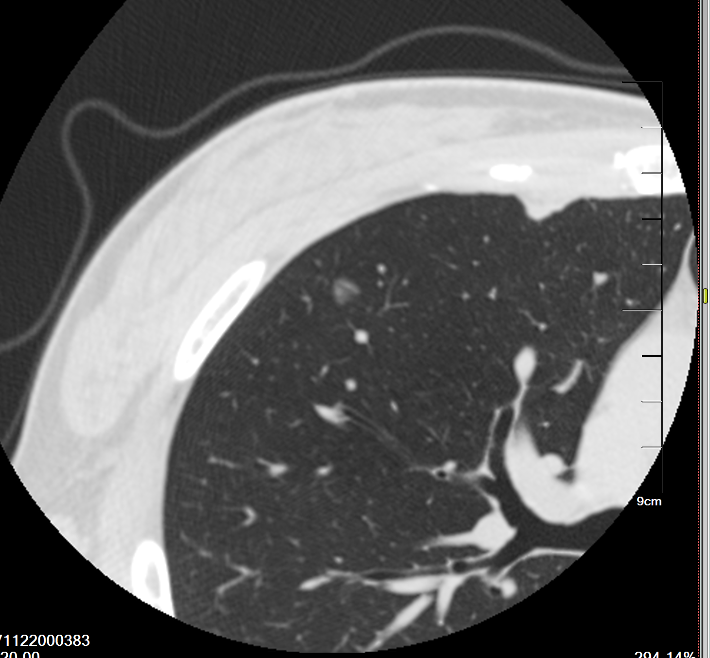 肺原位癌图片图片