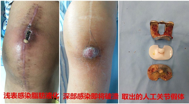 髋,膝人工关节置换术后感染了该怎么处理?