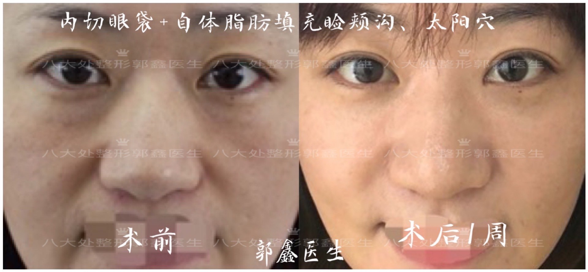 面部吸脂和去颊脂垫手术的区别👉小v脸是每个女生都梦_圈子-新氧美容整形