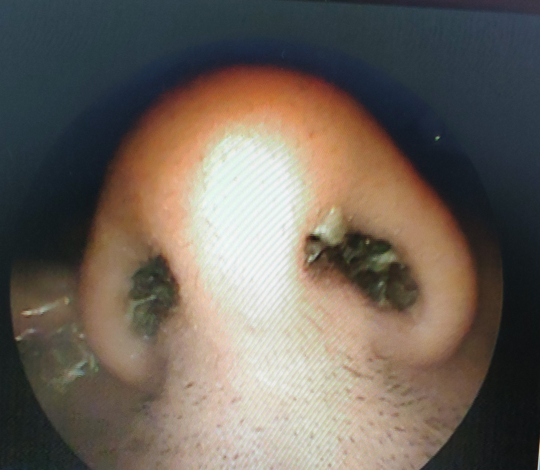 鼻息肉初期症状图片