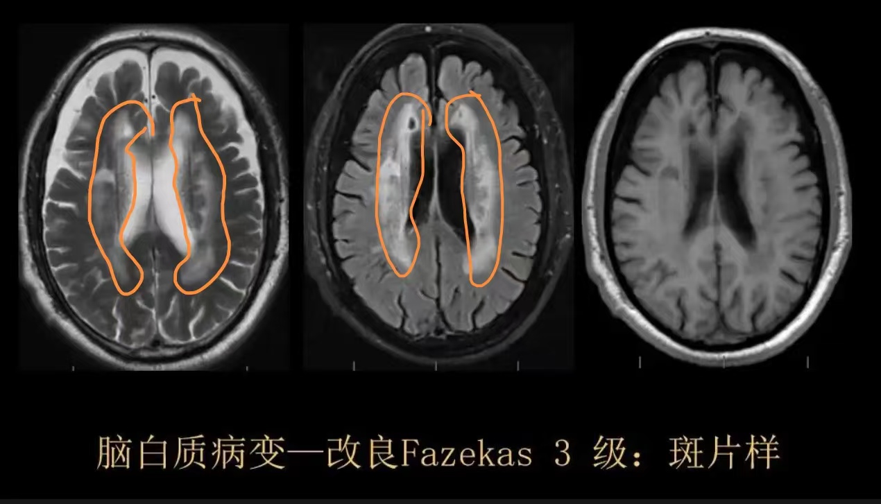 磁共振（MR）检查报告说的脑白质高信号Fazekas分级严重吗？_放射诊断_放射诊断介绍 - 好大夫在线