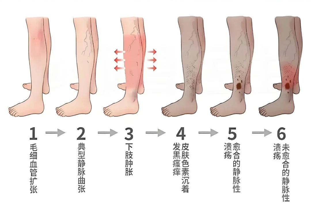 什么是轻微的静脉曲张 H2W8nt6LFTDGu1YQ6S001766168706.jpeg?_ms_=11e5